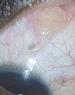 NEOflorax je pomogao riješiti se crva u oku